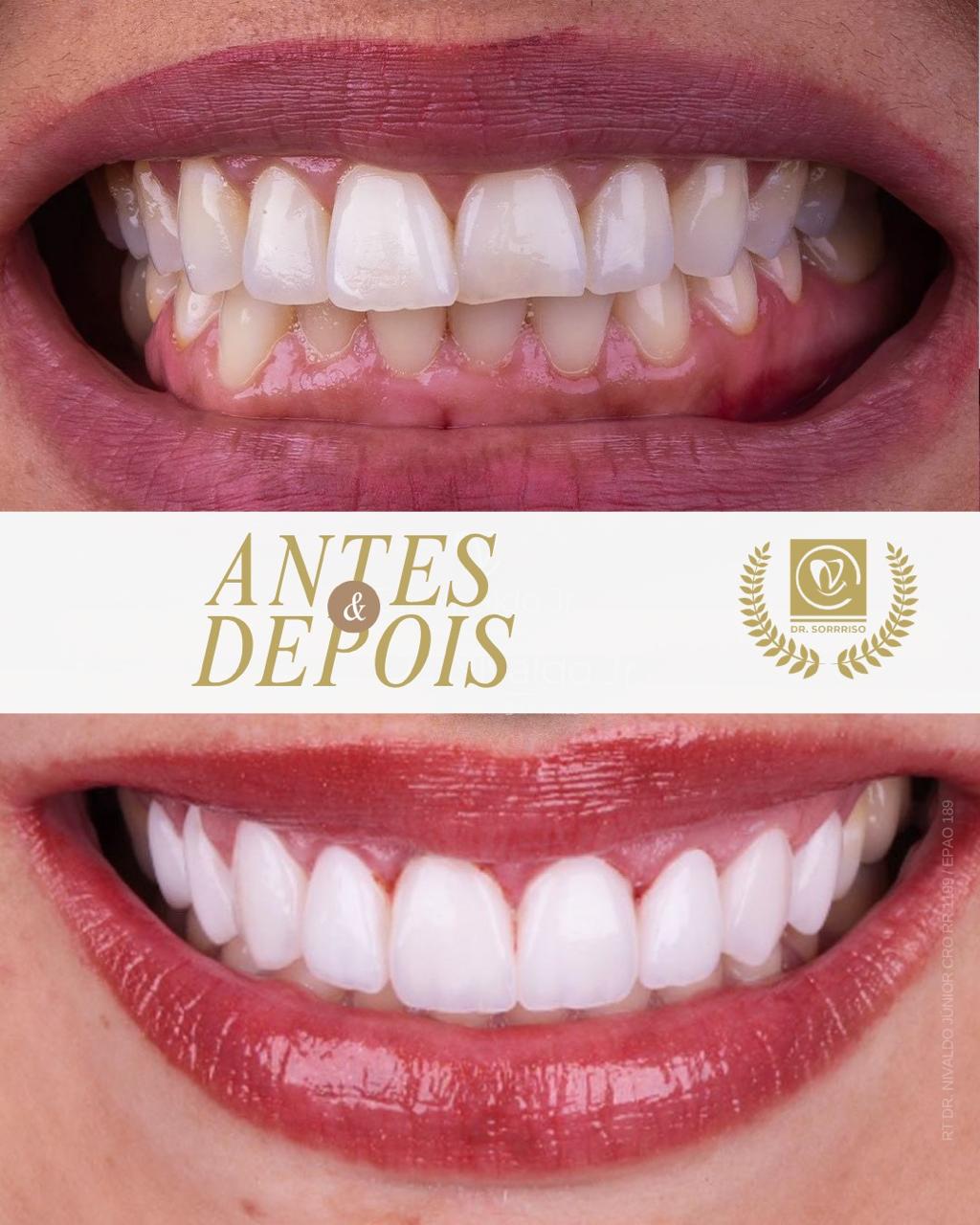 Antes e depois real de tratamento estético dental