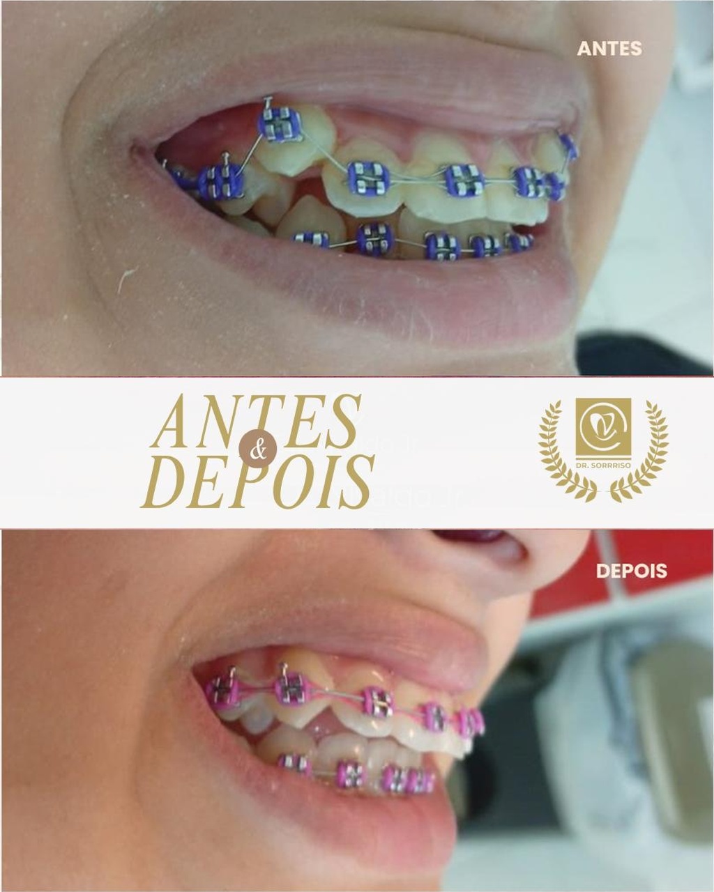 Antes e depois real de tratamento ortodôntico com aparelho